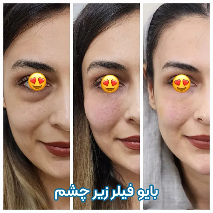 قبل بعد تزریق بایوفیلر زیر چشم