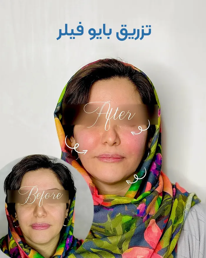 تزریق بایوفیلر صورت