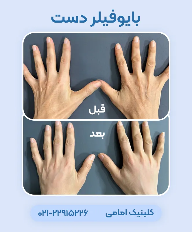 قبل بعد تزریق بایوفیلر دست