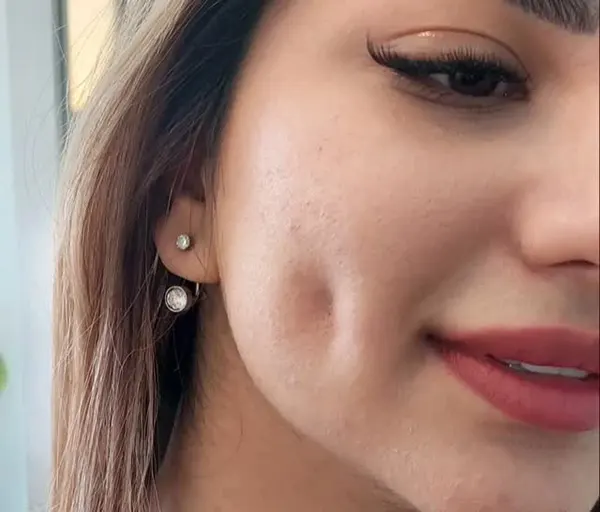 چال گونه با نخ