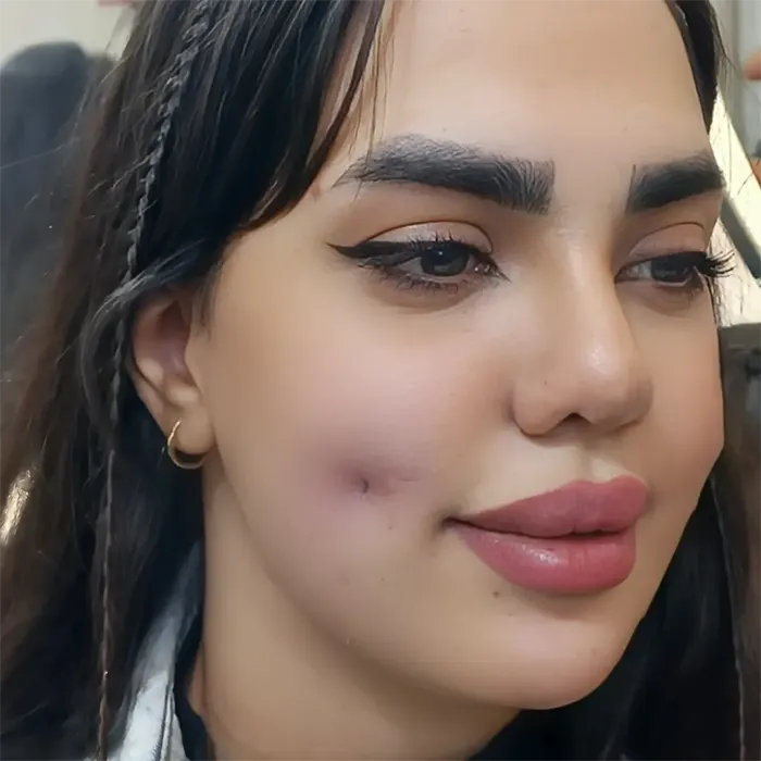 چال گونه با نخ