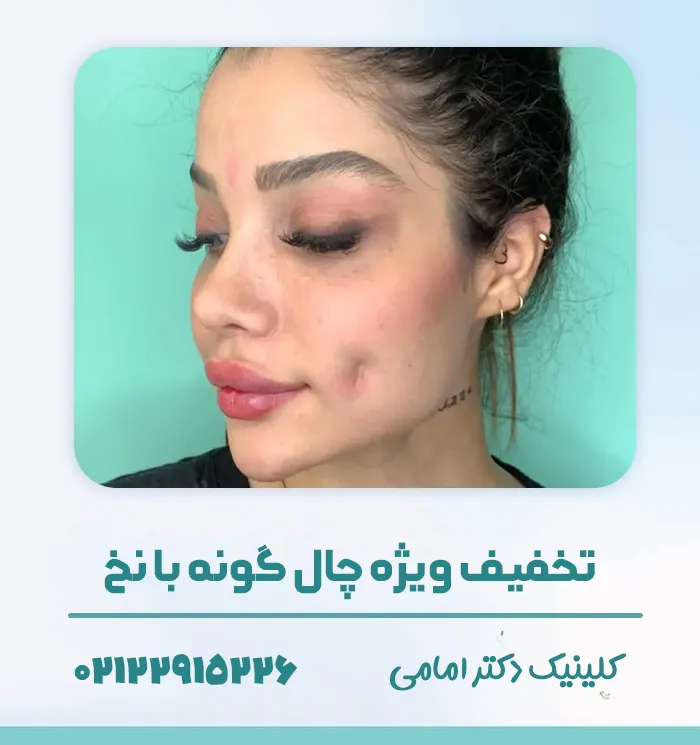 چال گونه با نخ