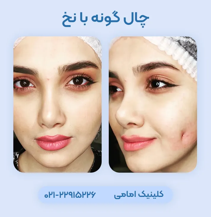 چال گونه با نخ