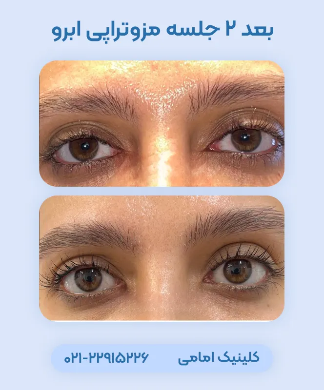 مزوتراپی ابرو قبل بعد