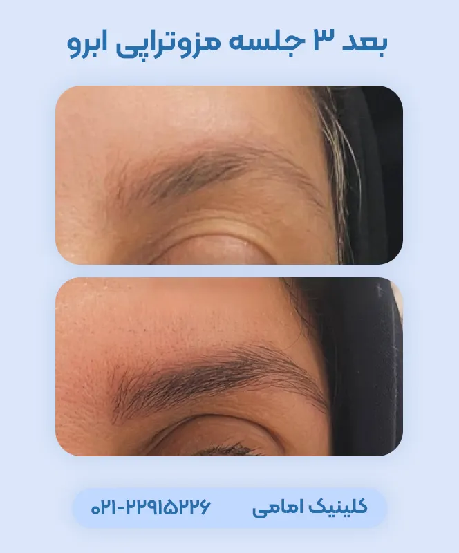 مزوتراپی ابرو قبل بعد