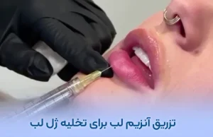 تزریق آنزیم لب برای تخلیه ژل لب