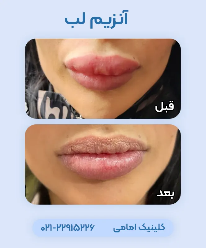 تزریق آنزیم لب