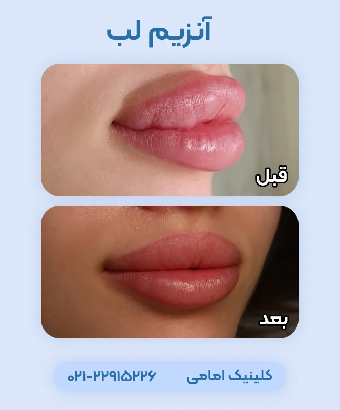 تزریق آنزیم لب