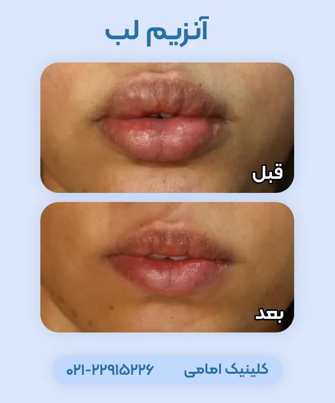 تزریق آنزیم لب