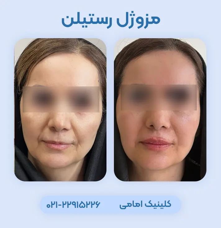 مزوژل رستیلن