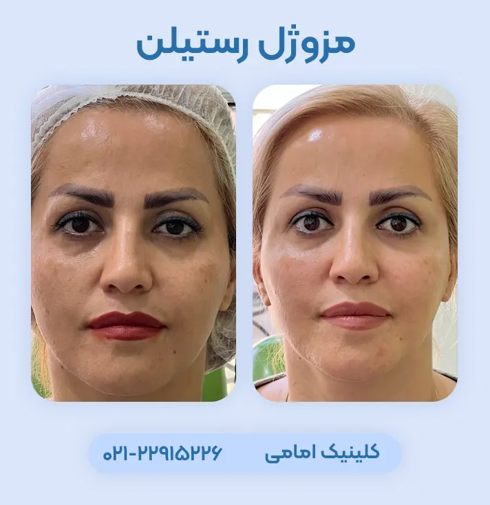 قبل و بعد مزوژل رستیلن