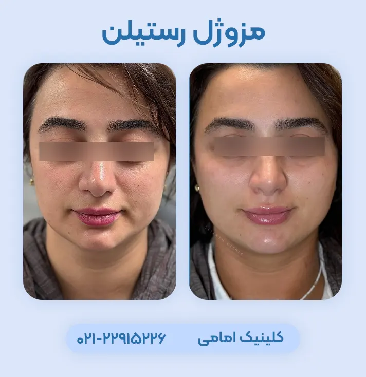 مزوژل رستیلن قبل بعد