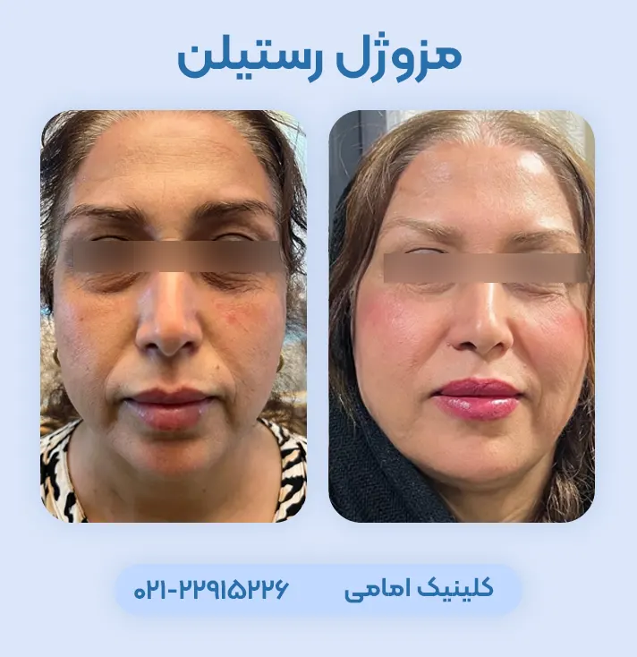 تزریق مزوژل رستیلن