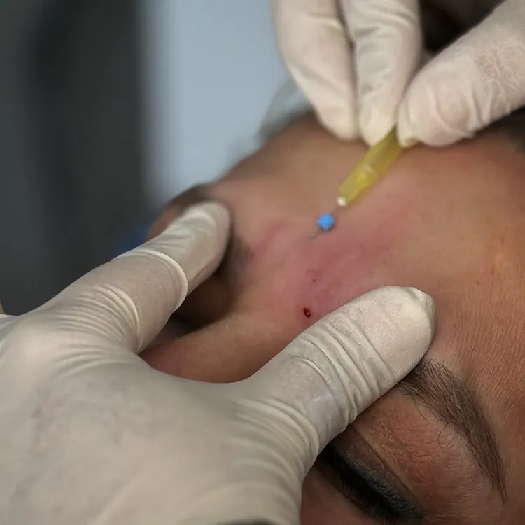 درمان خط اخم با نخ