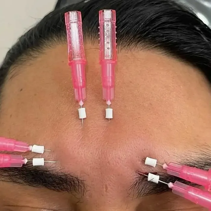 درمان خط اخم با نخ