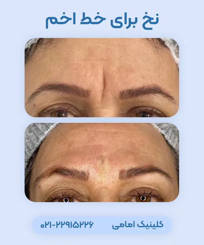 درمان خط اخم با نخ