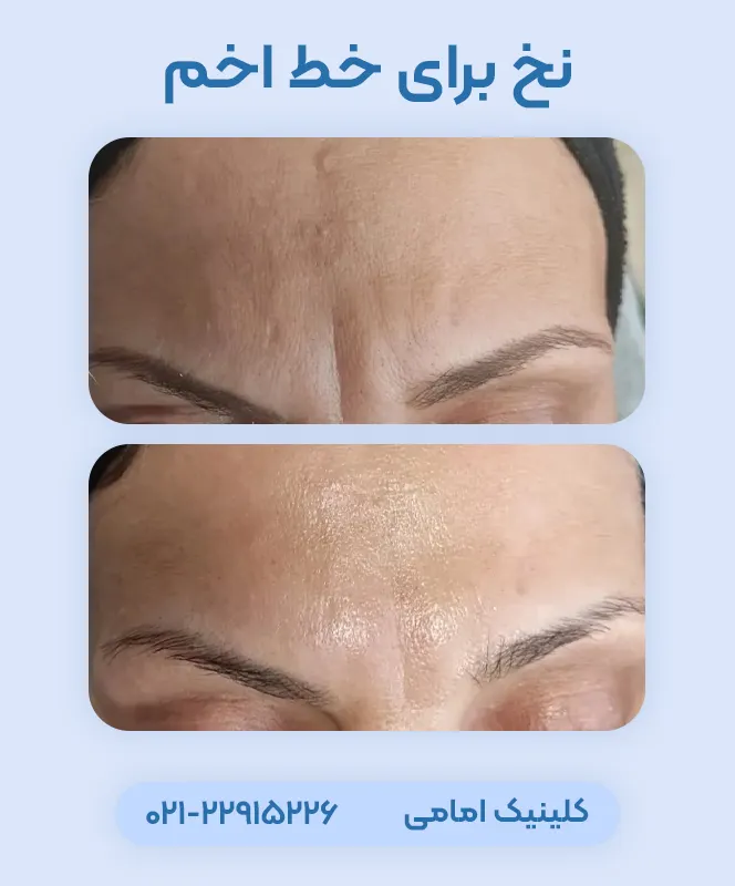 درمان خط اخم با نخ