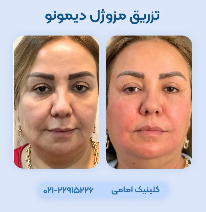 قبل و بعد مزوژل دیمونو