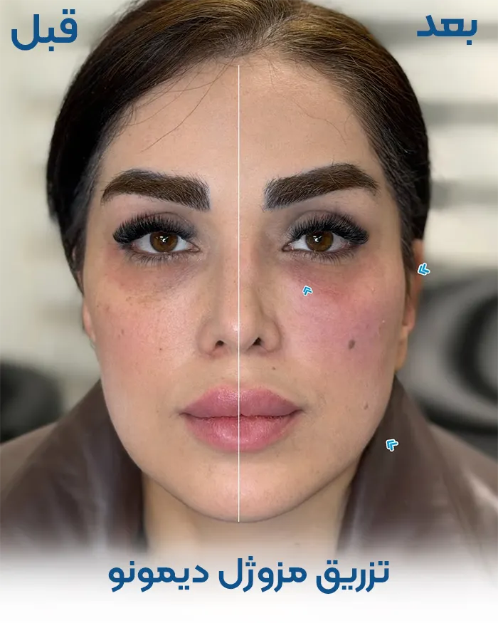 قبل و بعد دیمونو