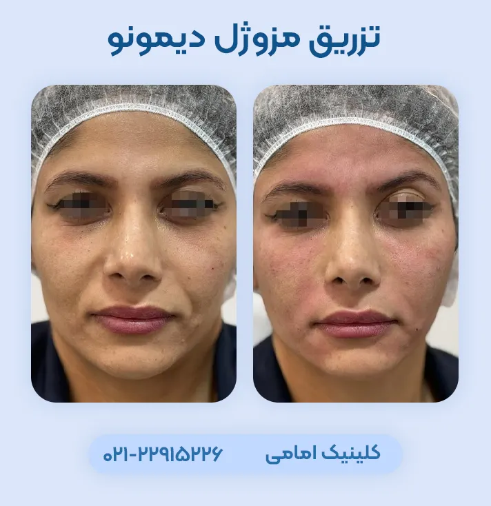 قبل و بعد مزوژل دیمونو