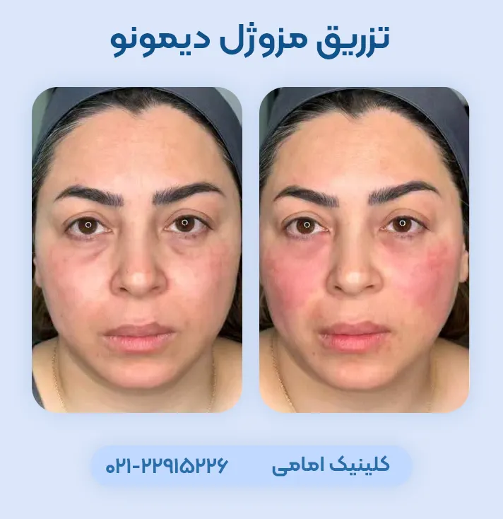 قبل و بعد مزوژل دیمونو