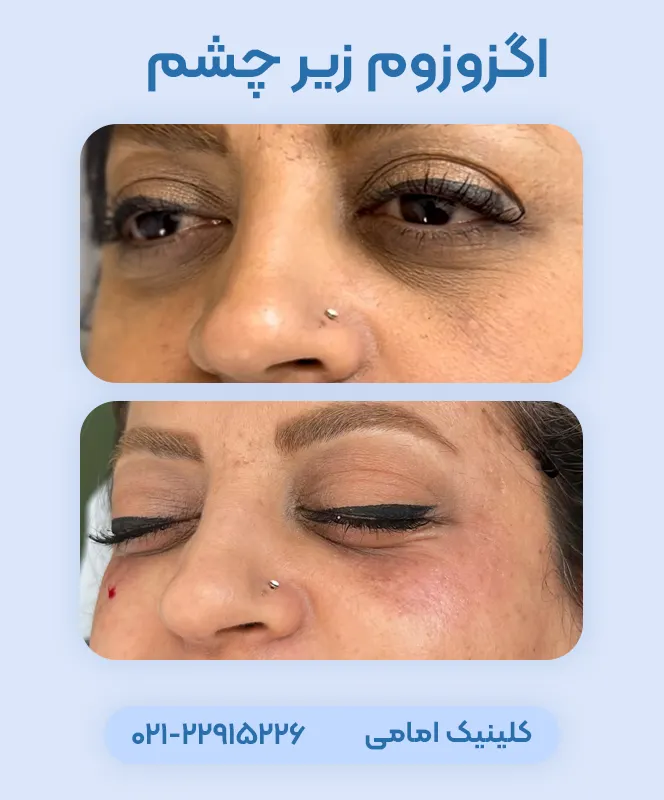 اگزوزوم زیر چشم