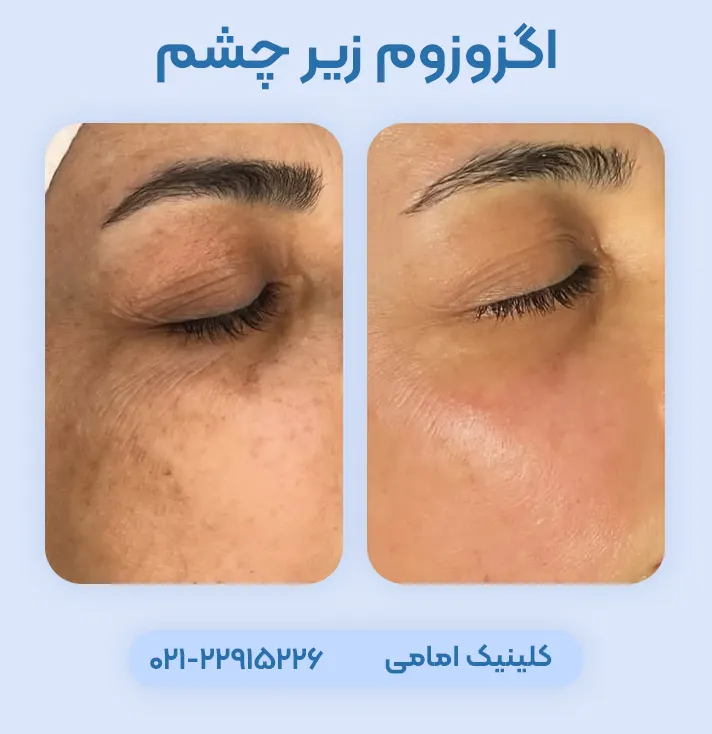 عکس قبل بعد اگزوزوم زیر چشم