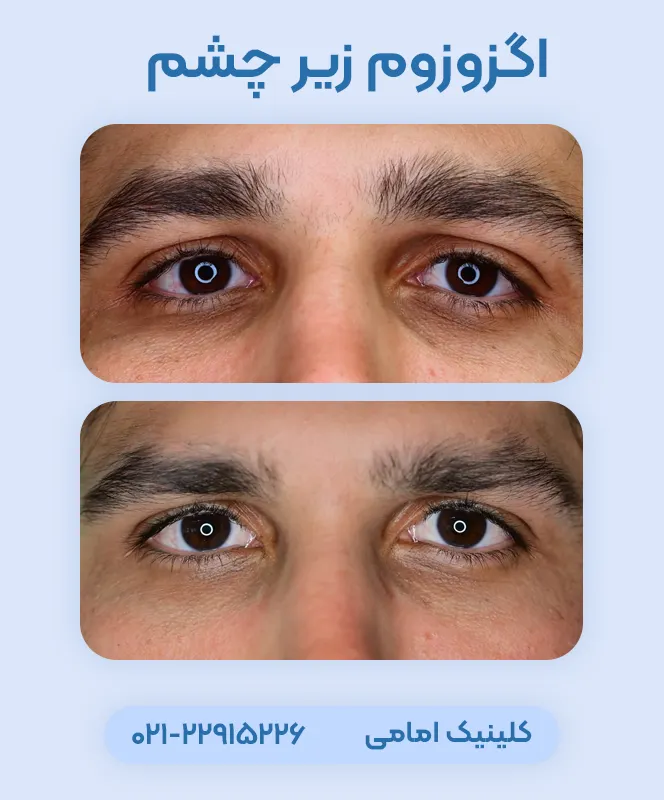 اگزوزوم برای زیر چشم