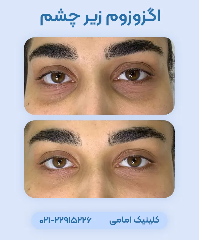 اگزوزوم تراپی زیر چشم قبل بعد