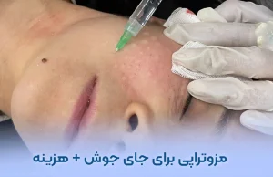 مزوتراپی برای جای جوش
