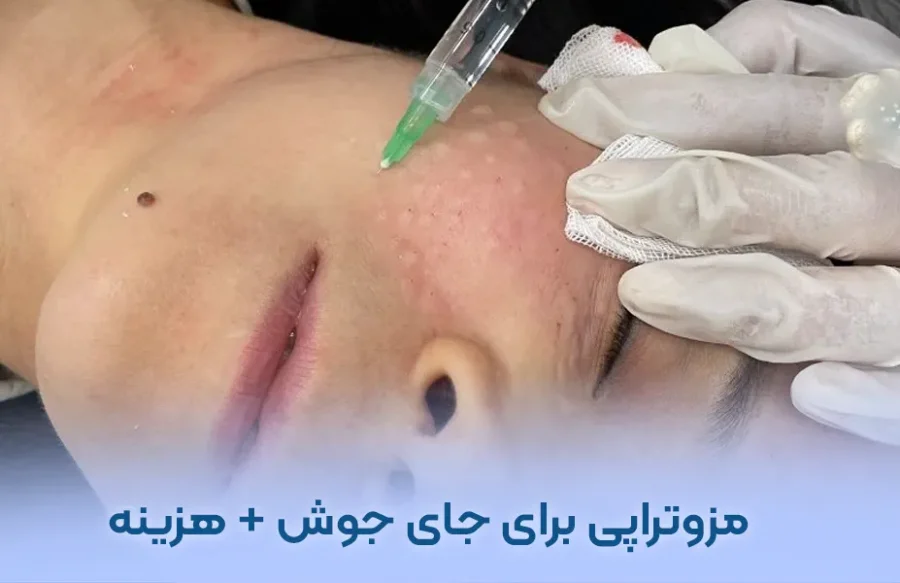 مزوتراپی برای جای جوش