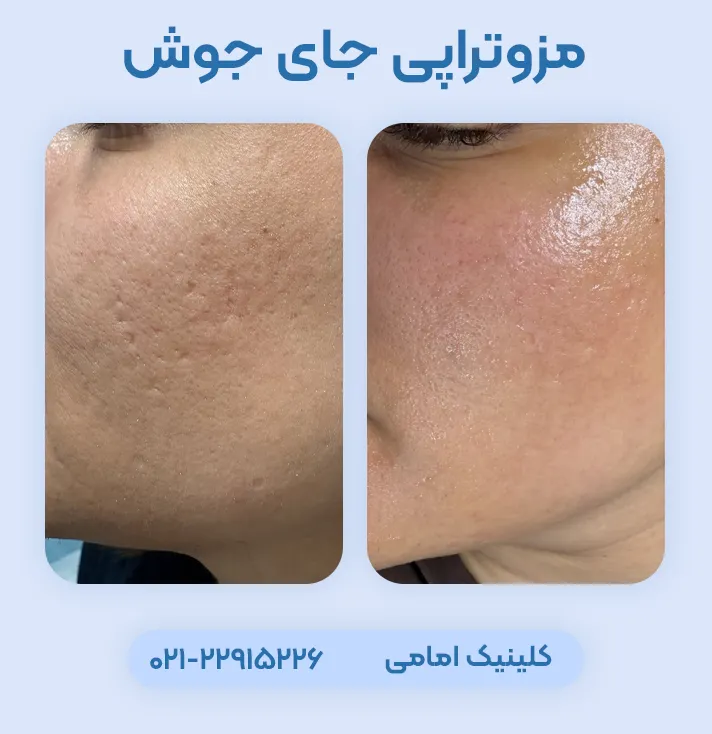 مزوتراپی اسکار جای جوش