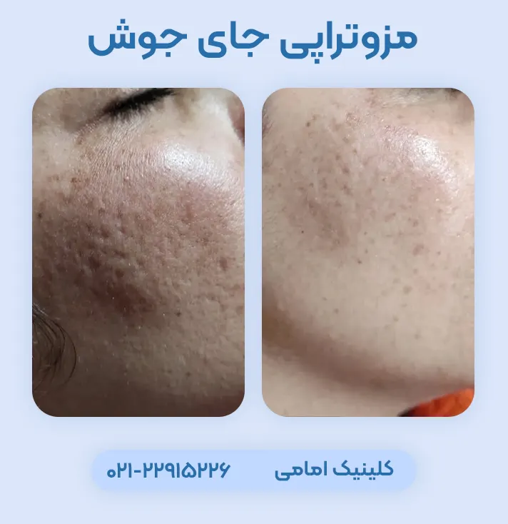 مزوتراپی اسکار جوش
