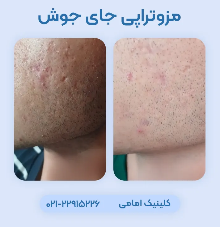 مزوتراپی برای جای جوش