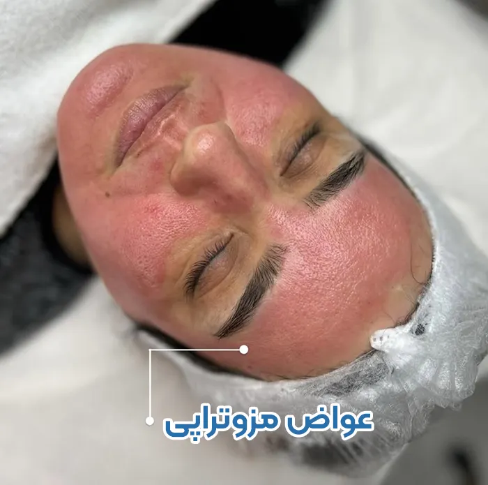 عوارض جانبی مزوتراپی