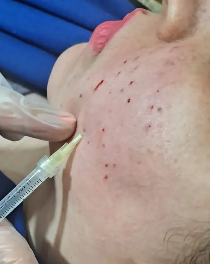 تزریق مزوتراپی جوش صورت