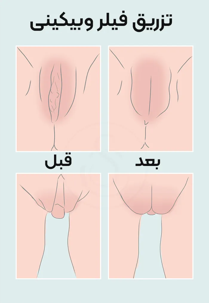 قبل و بعد تزریق فیلر بیکینی