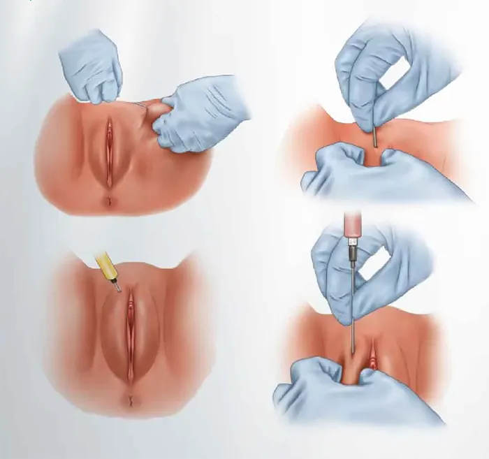 تزریق ژل به بیکینی