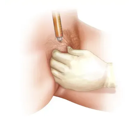 تزریق فیلر بیکینی