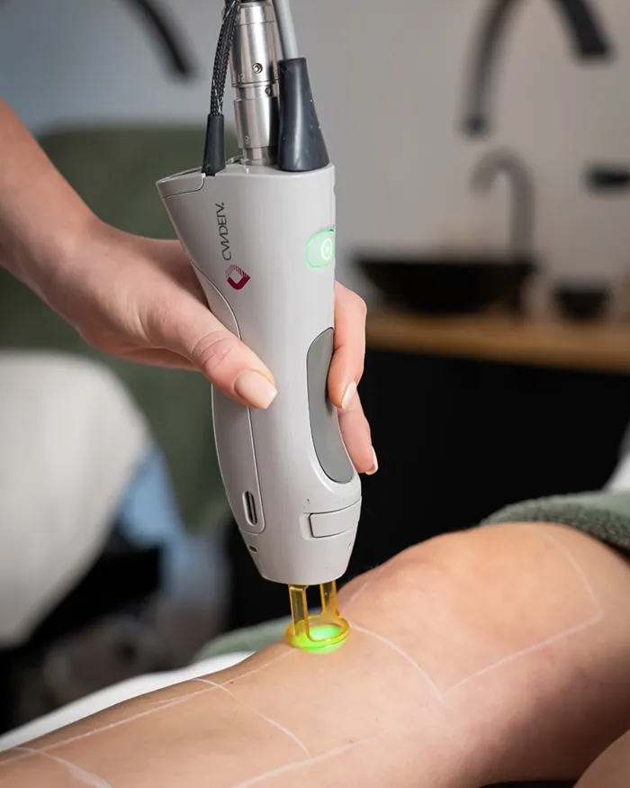 لیزر موهای زائد آقایان