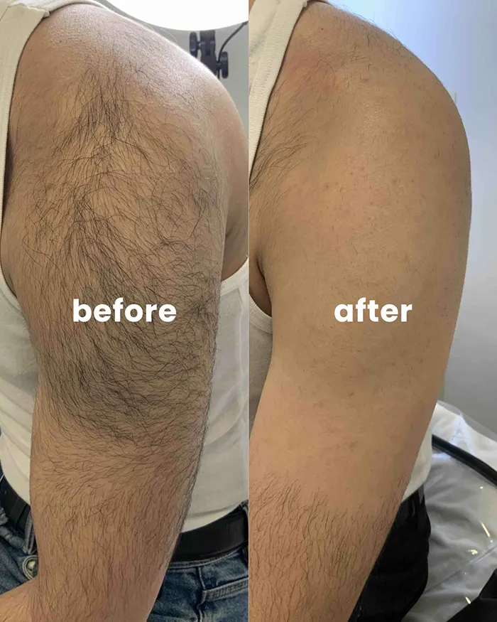 لیزر موهای زائد آقایان