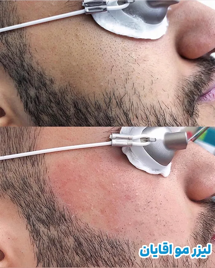 لیزر موهای زائد آقایان