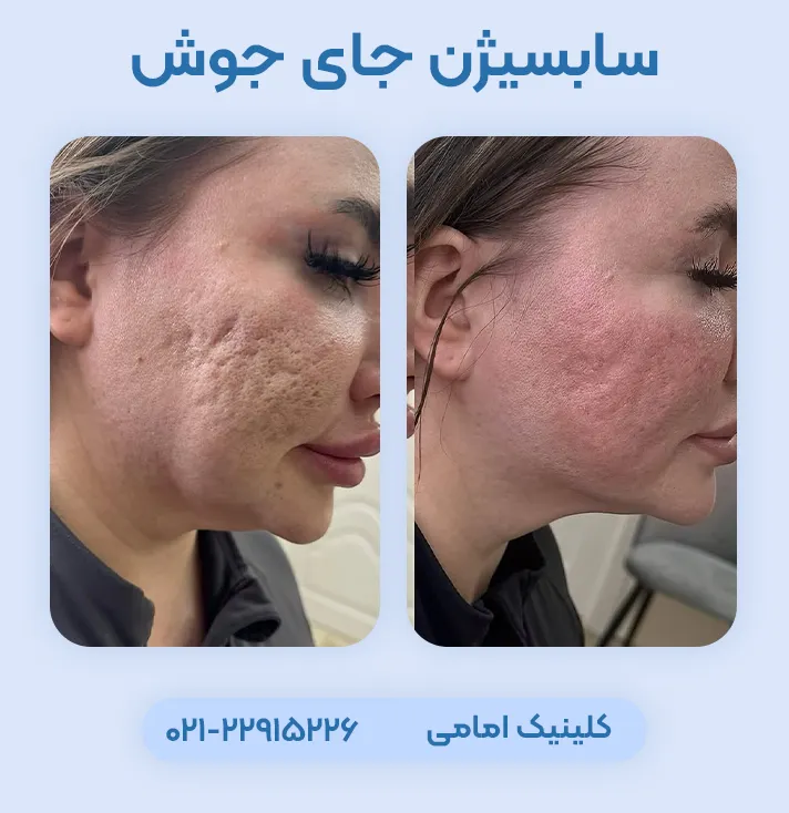 سابسیژن جای جوش