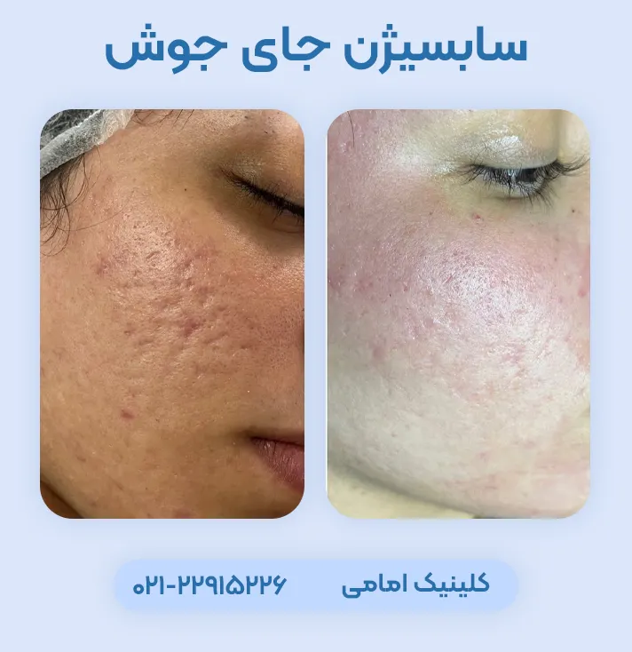 سابسیژن جای جوش