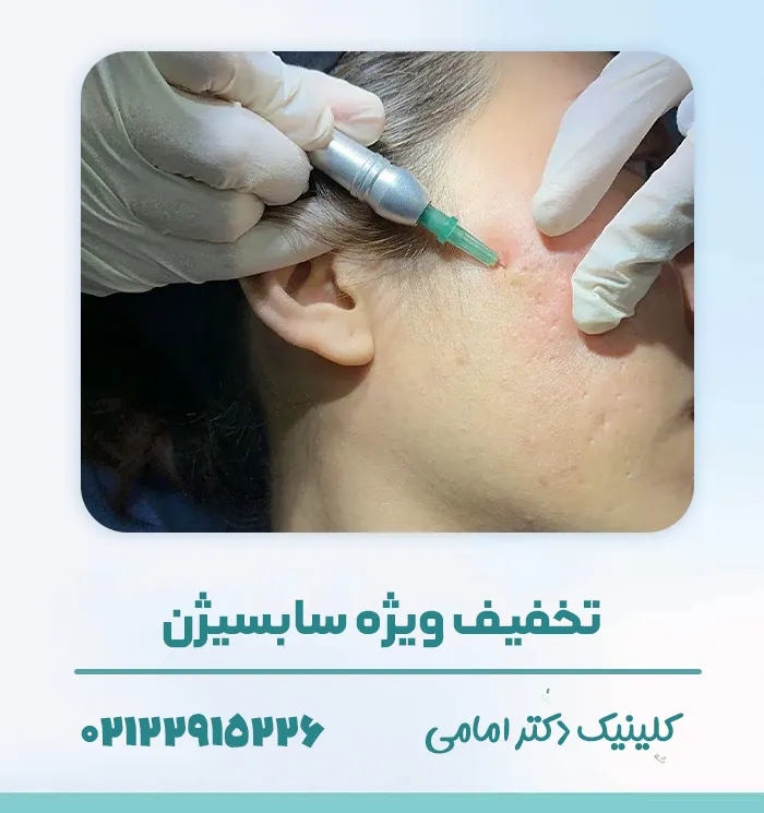 سابسیژن جای جوش تهران