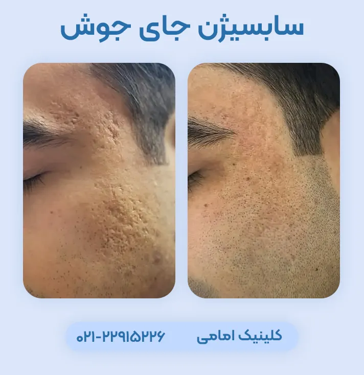 سابسیژن جای جوش