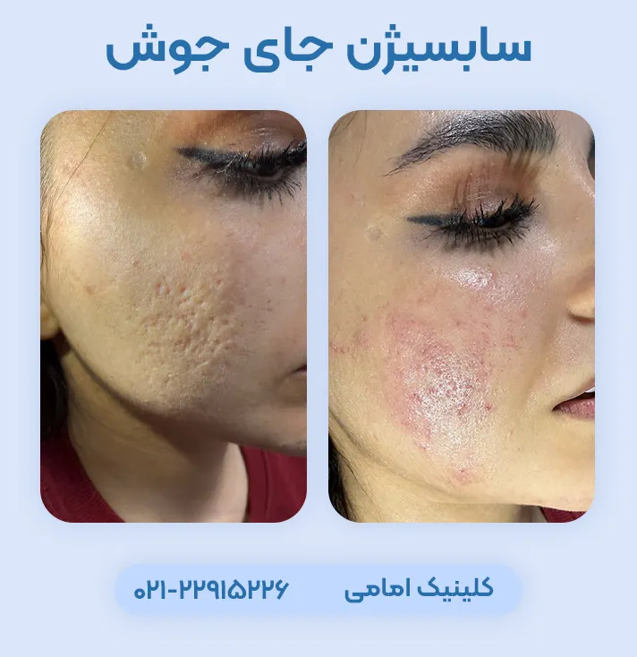 سابسیژن جای جوش