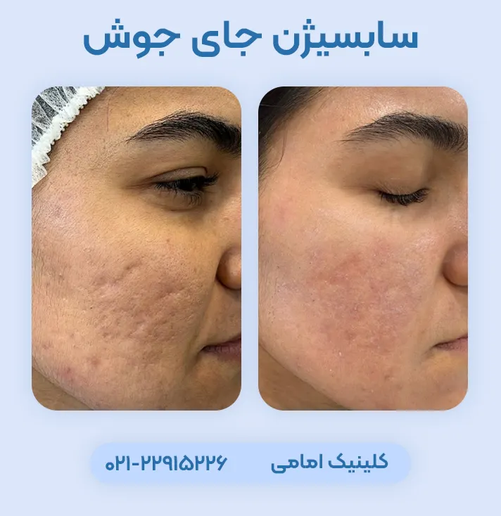 سابسیژن جای جوش