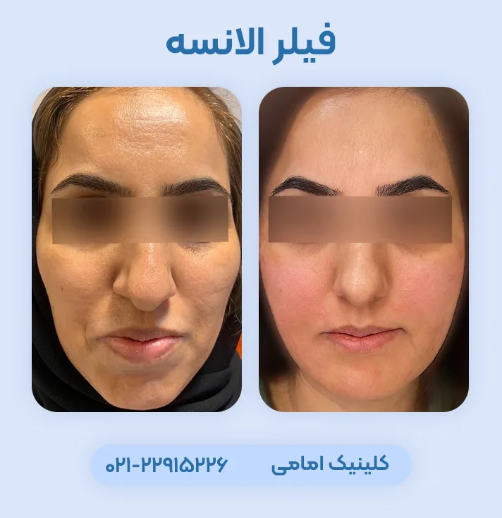 فیلر الانسه قبل بعد