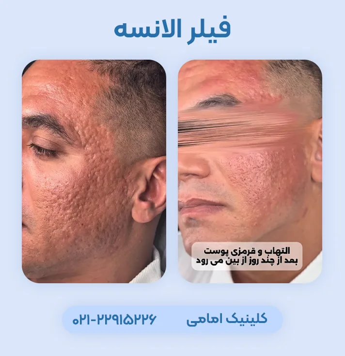 فیلر الانسه برای اسکار و جای جوش